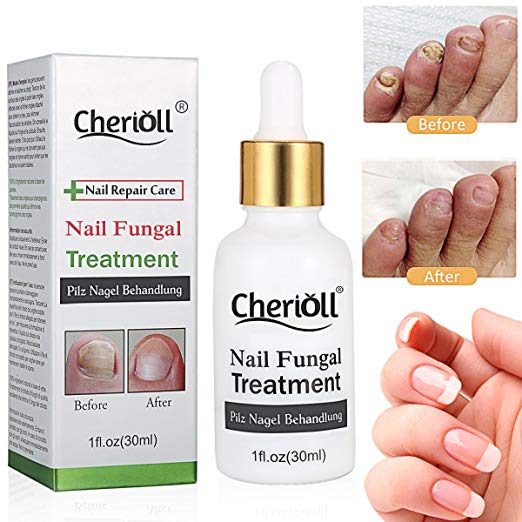 Nail Antifungal Treatment,Nail Fungus Treatments,Anti Fungus Nail Treatment,Fungus Stop,Effective against nail fungus,Restores Toenail Fungus (2pcs)